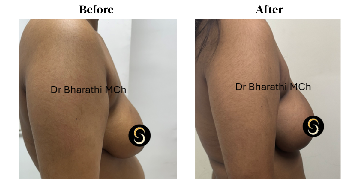 Breast Implant in Chennai