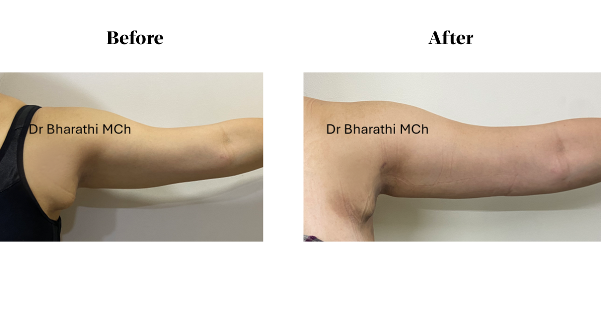 Axillary breast removal in chennai