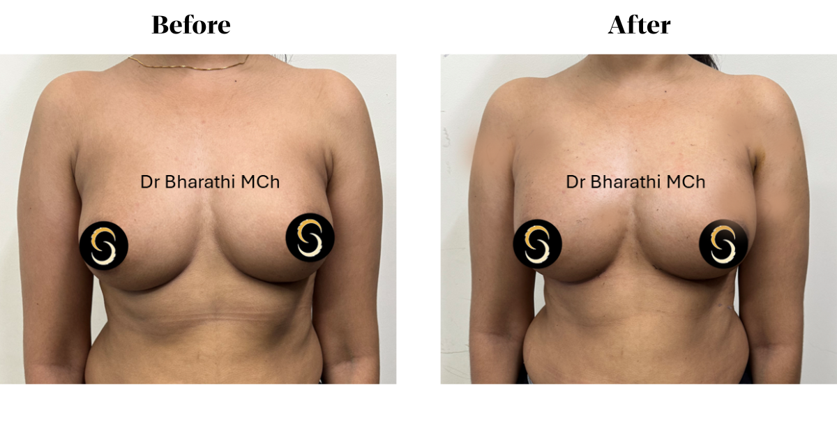 Breast fat fill in Chennai Breast fat fill in Chennai