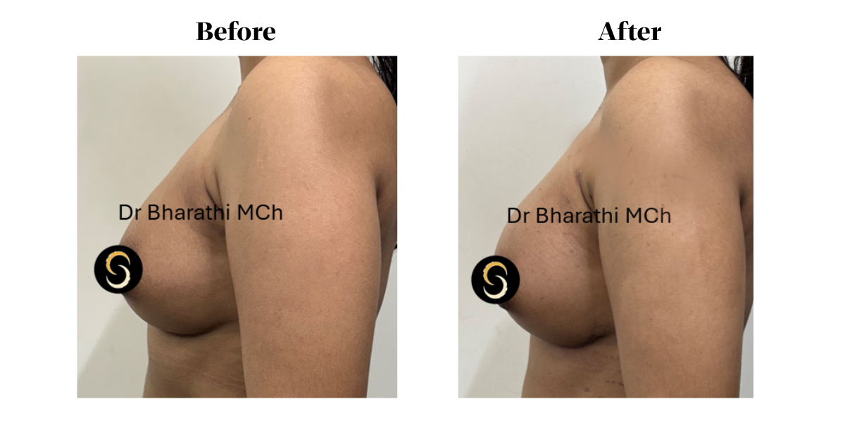 Breast fat fill in Chennai Breast Fat fill in chennai