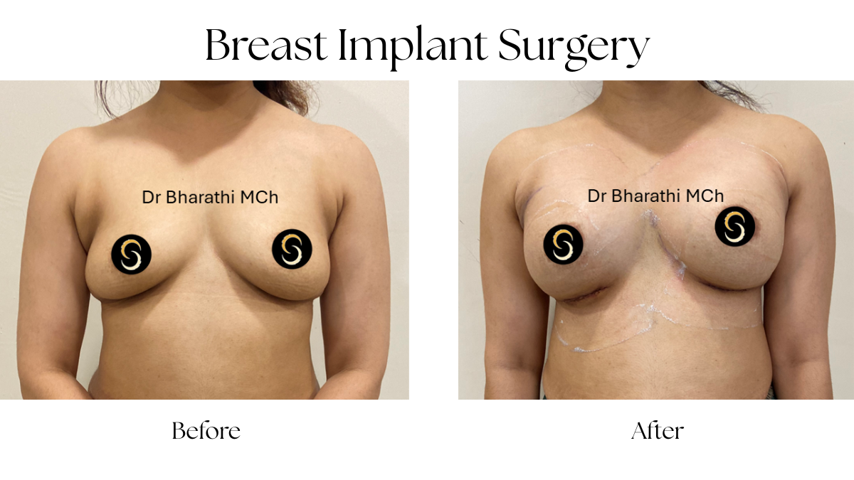 Breast Implant in Chennai
