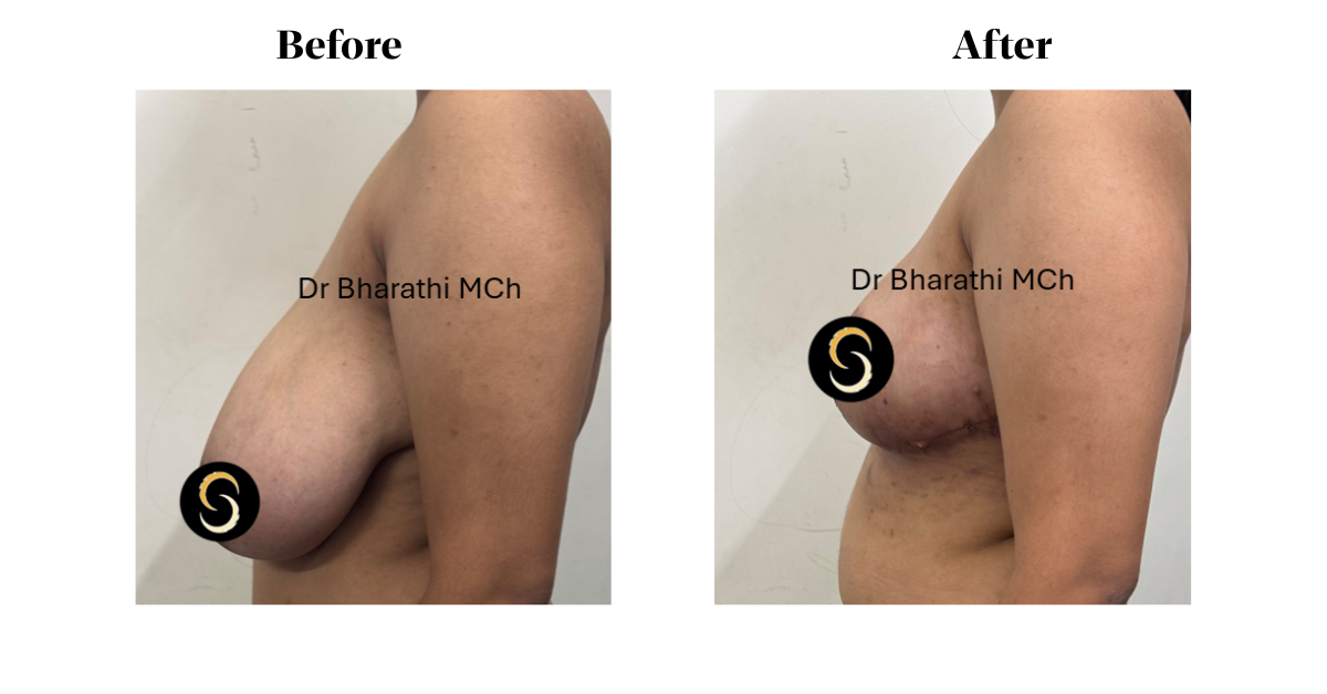 Breast Reduction Surgery in Chennai