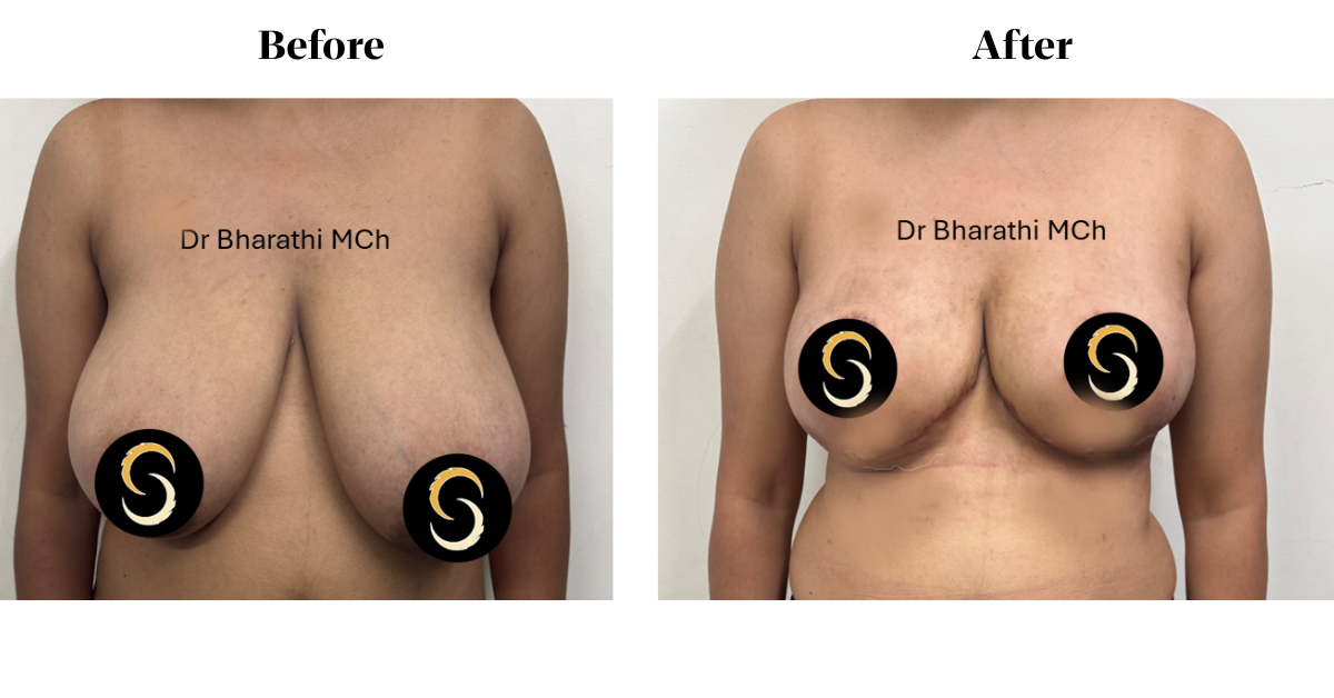Breast Reduction Surgery in Chennai