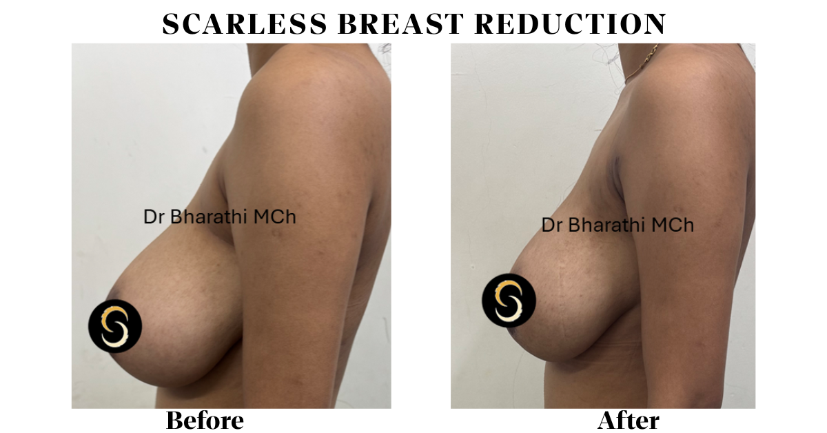 Scarless breast reduction in chennai Scarless breast reduction in chennai